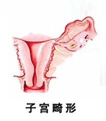 宫颈畸形是如何造成女性不孕的?