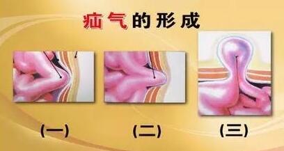 小儿疝气能不能自己痊愈