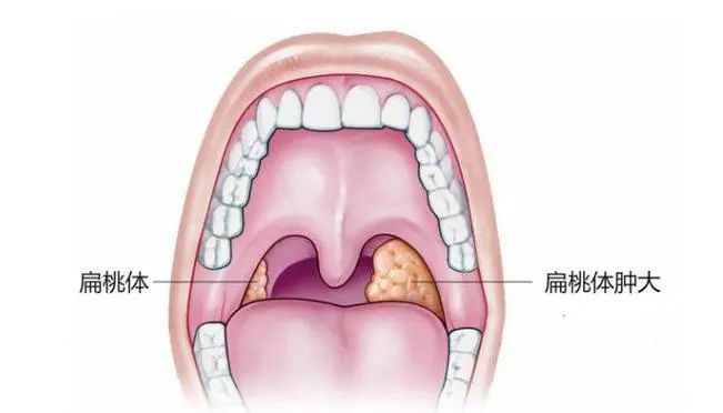 合肥扁桃体肥大怎么治疗