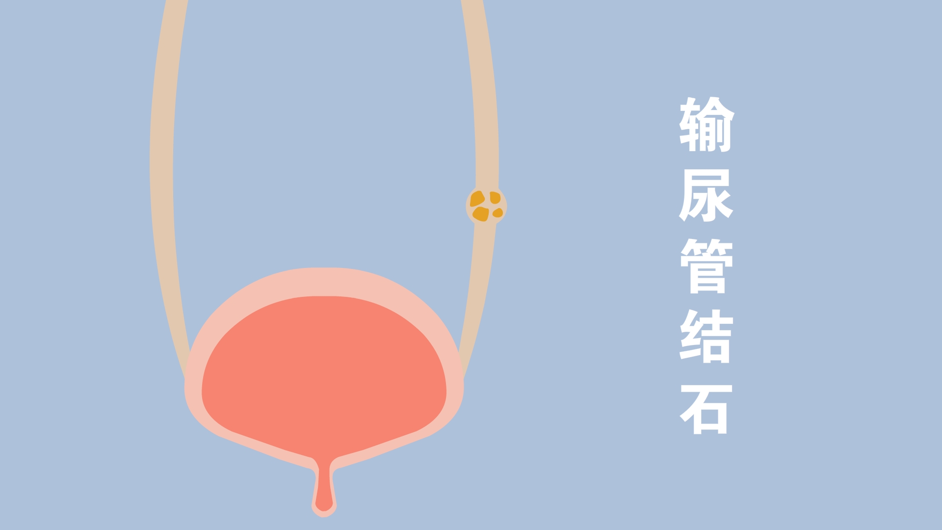 输尿管结石有什么危害