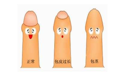 哪些情况需要做包皮过长手术