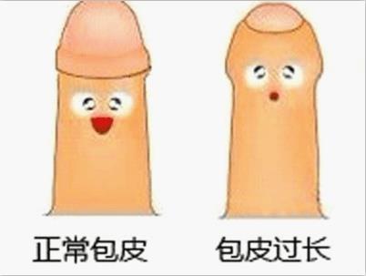 做包皮手术之前需要了解哪些问题