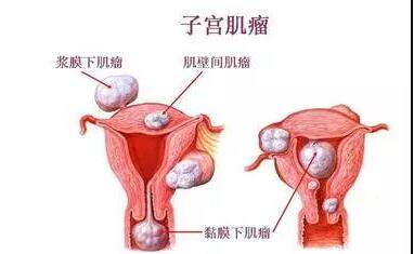 子宫肌有哪些症状