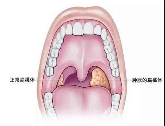 扁桃體發(fā)炎有哪些危害