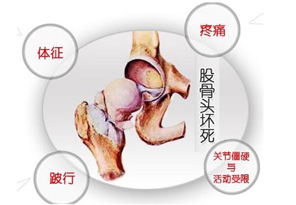 导致股骨头坏死的原因有哪些