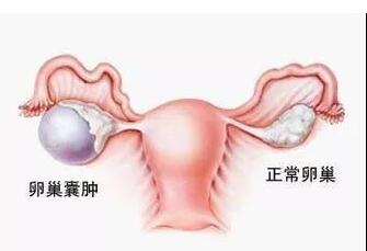 为什么卵巢囊肿会导致女性不孕