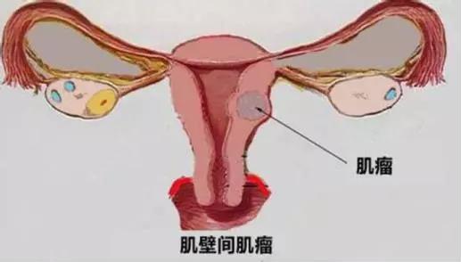 导致子宫肌的原因有哪些