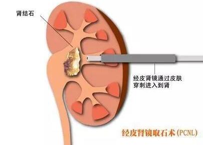 你知道肾结石的四大症状吗