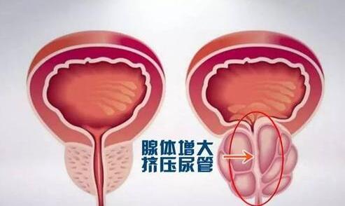 引起前列腺肥大的原因有哪些