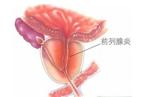 B超可以查出前列腺炎吗？查出前列腺炎怎么办？