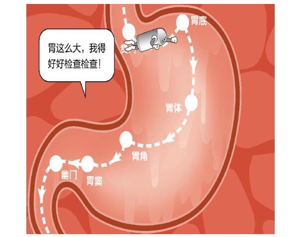 胶囊胃镜的技术优势和适用人群