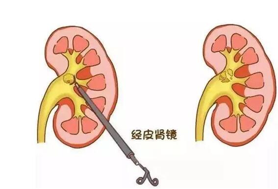 确诊肾结石需要做哪些检查